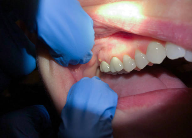 Best Dental Abscess Treatment in Ellijay, GA